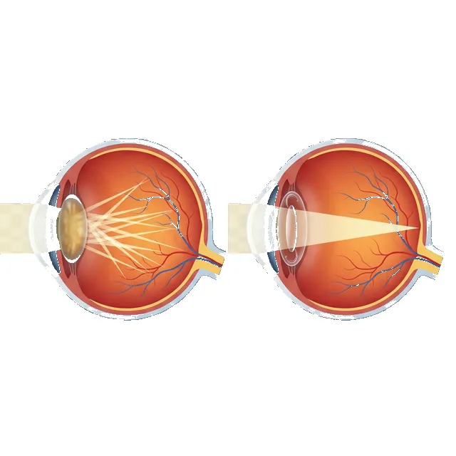 Diagram showing how light scatters through a cataract versus focusing clearly through a healthy lens