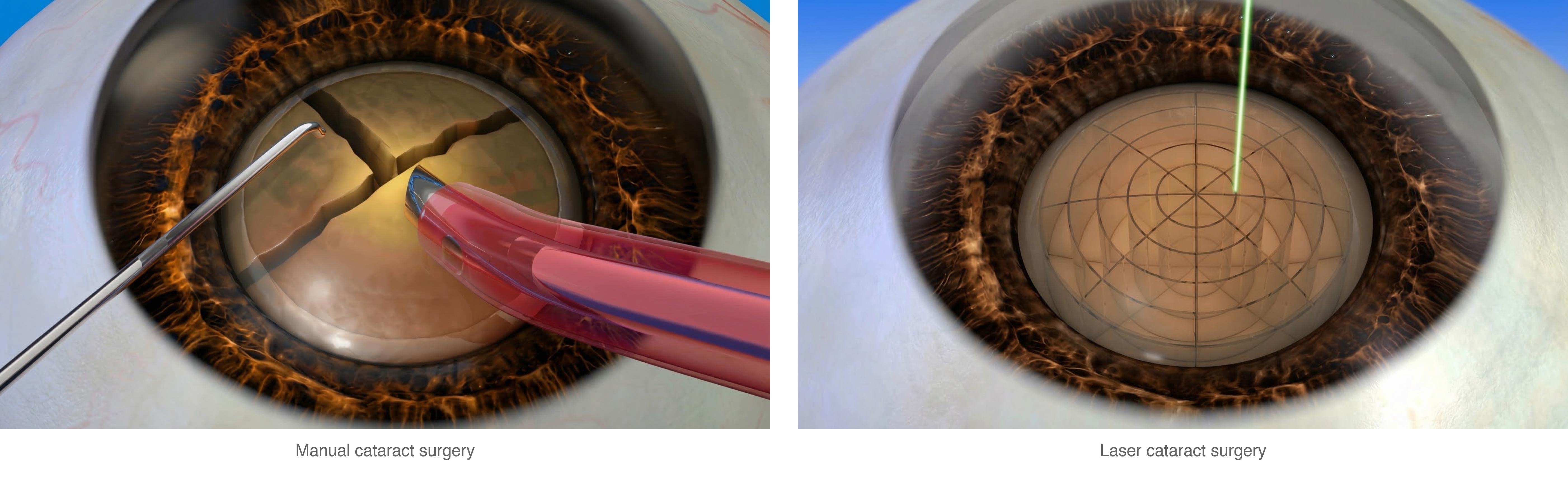 Manual cataract surgery versus laser-assisted cataract surgery comparison